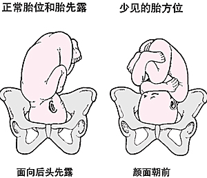 胎位异常一般指妊振30周后,胎儿在子宫体内的位置不正,较长见于腹